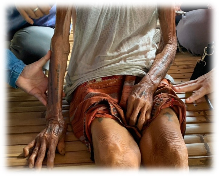 รอยสักบนเรือนร่างของผู้สูงอายุเพศหญิง
